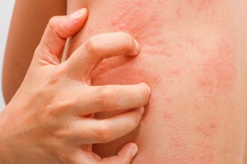 Nổi phát ban do dị ứng nấm mốc