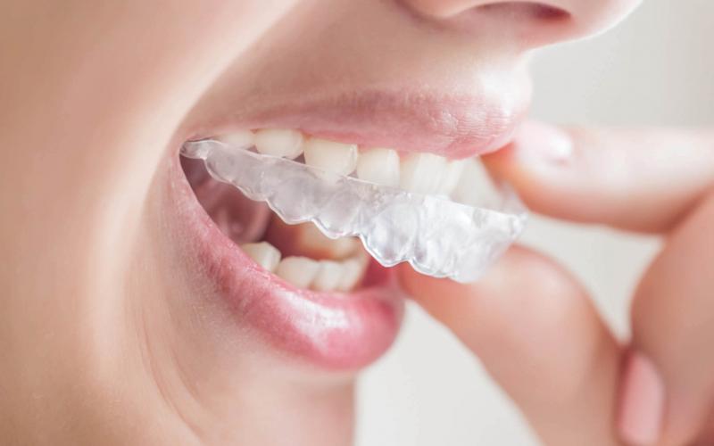 Bảo hiểm y tế có hỗ trợ chi phí cho việc sử dụng Invisalign không và làm thế nào để xác định phạm vi bảo hiểm?