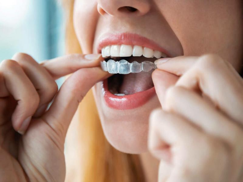 Bảo hiểm y tế có hỗ trợ chi phí cho việc sử dụng Invisalign không và làm thế nào để xác định phạm vi bảo hiểm?
