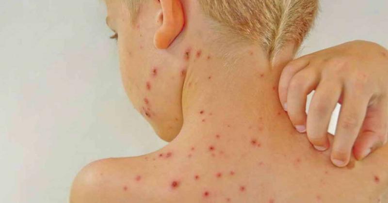 Uống nước ấm mỗi ngày để bảo vệ làn da khỏi nhiễm trùng như trên