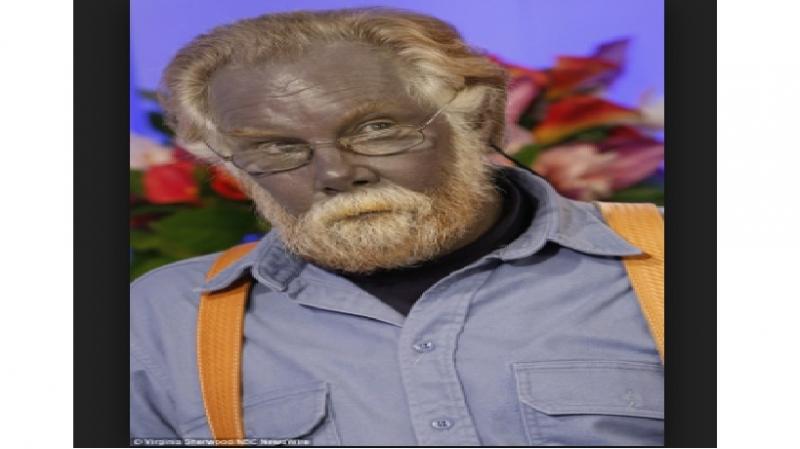 Paul Karason bị bệnh Argyria khiến làn da của ông có màu xanh