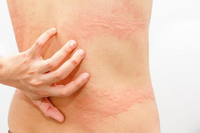 Bị dị ứng da vẽ nổi ở mức độ nặng