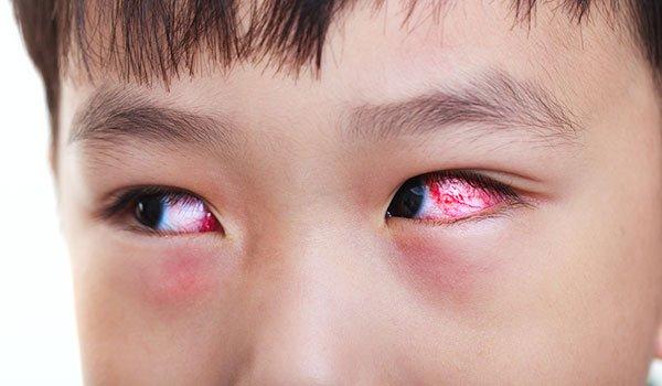 Bệnh đau mắt đỏ