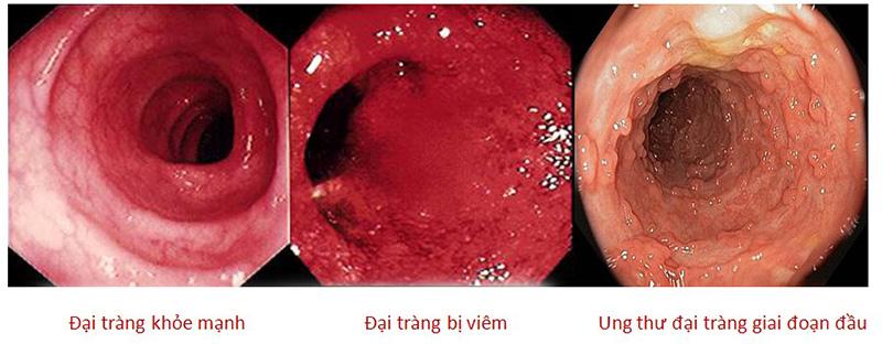 Ung thư đại tràng