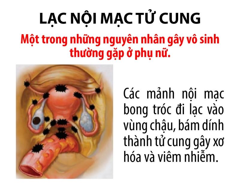 Lạc nội mạc tử cung là nguyên nhân chính gây vô sinh ở phụ nữ