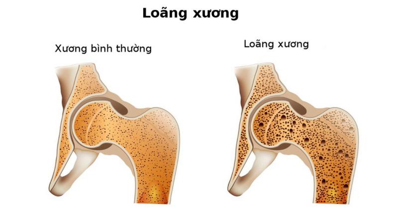 Bệnh loãng xương là gì?