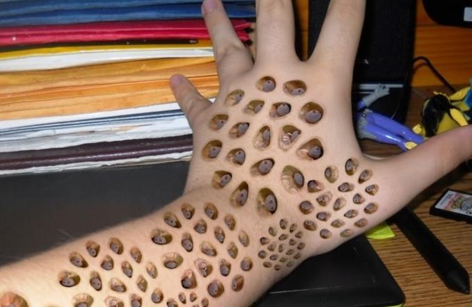 Bệnh nhiễm trùng giòi maggot