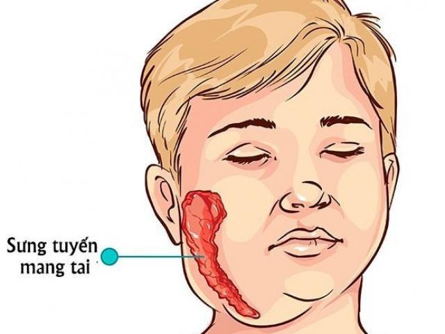 Bệnh quai bị
