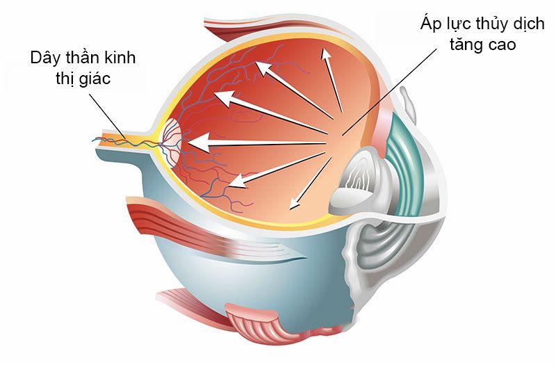 Bệnh tăng nhãn áp là gì?