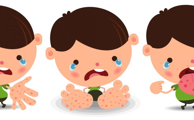 Bệnh tay chân miệng ở trẻ nhỏ
