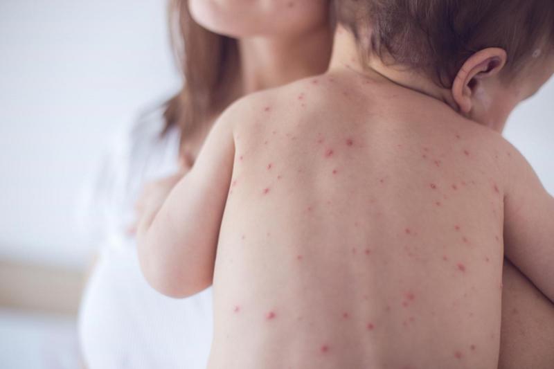 Bệnh thủy đậu là một bệnh cấp tính do nhiễm virus Varicella Zoter gây ra