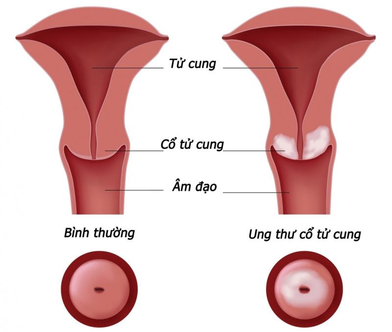Bệnh ung thư cổ tử cung thường gặp ở độ tuổi từ 30-59