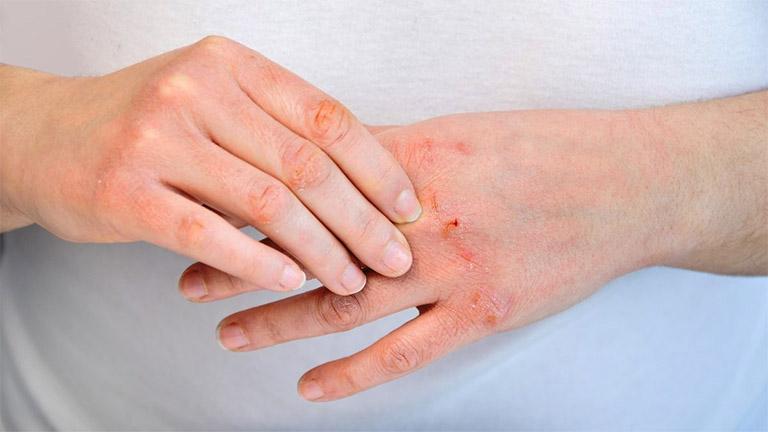 Bệnh viêm da cơ địa có thể phòng chống hay không?