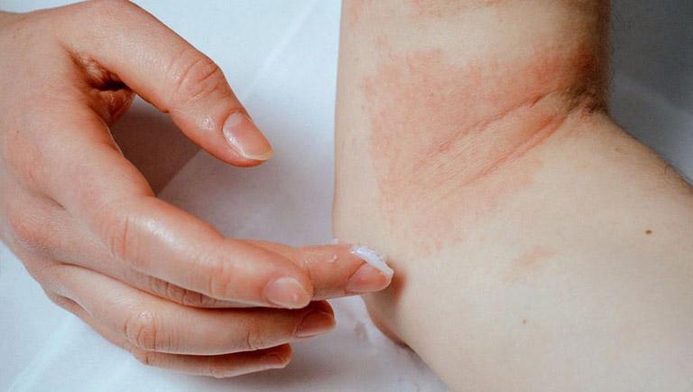 Bệnh viêm da cơ địa có thể phòng chống hay không?