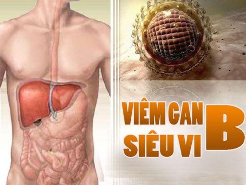 Bệnh viêm gan siêu vi B