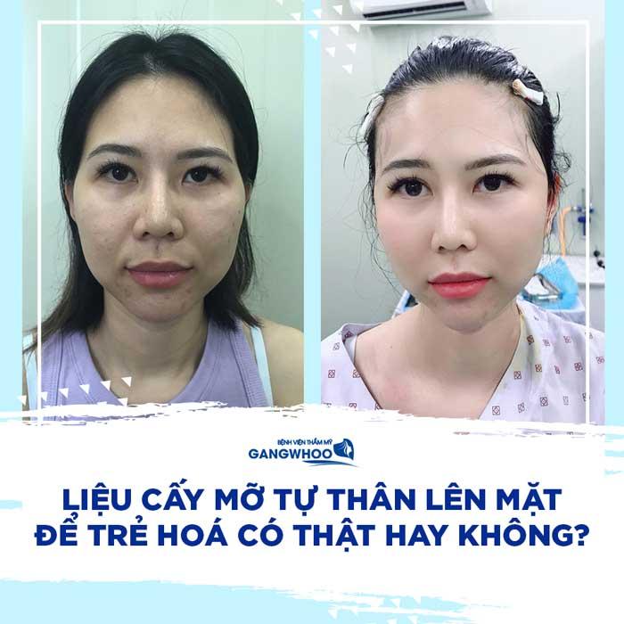 Cấy mỡ mặt tại Bệnh viện thẩm mỹ Gangwhoo