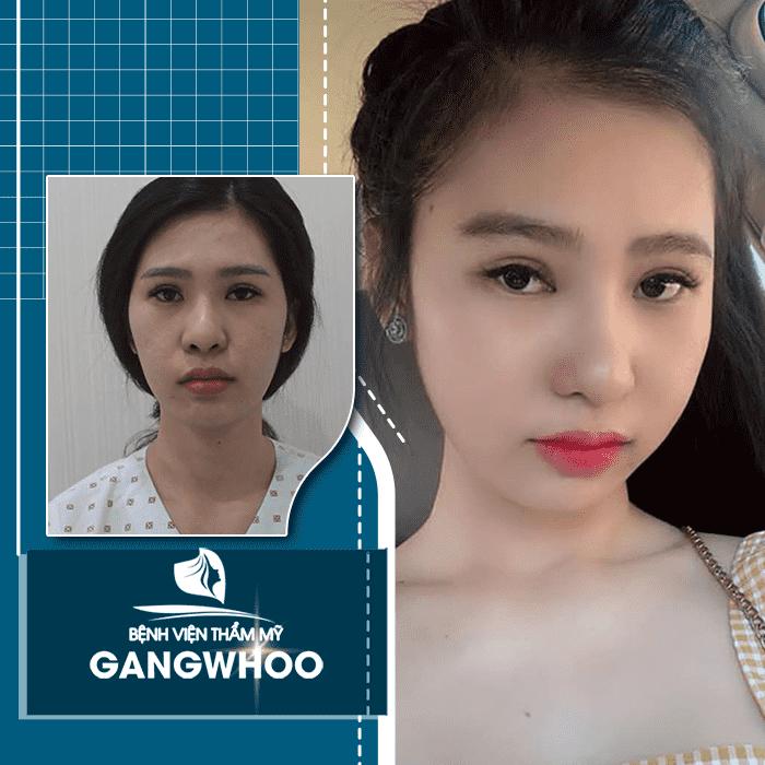 Cấy mỡ mặt tại Bệnh viện thẩm mỹ Gangwhoo