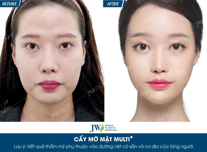 Cấy mỡ mặt tại Bệnh viện thẩm mĩ JW Hàn Quốc