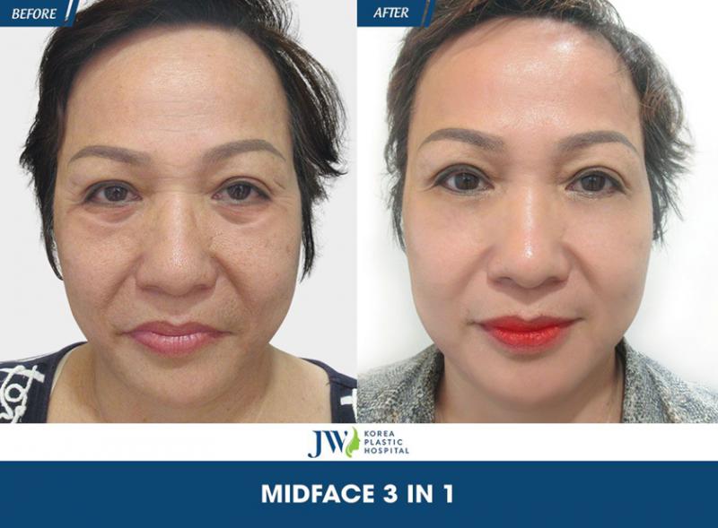 Cấy mỡ mặt tại Bệnh viện thẩm mĩ JW Hàn Quốc