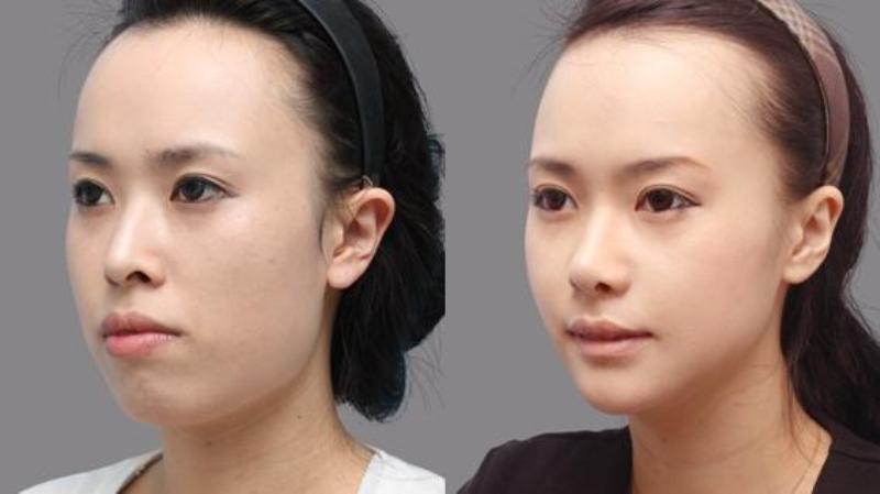 Kết quả trước và sau phẫu thuật hàm hô tại TMV Á Âu