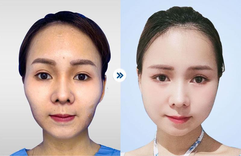 Cấy mỡ mặt tại Bệnh viện thẩm mỹ Kang Nam