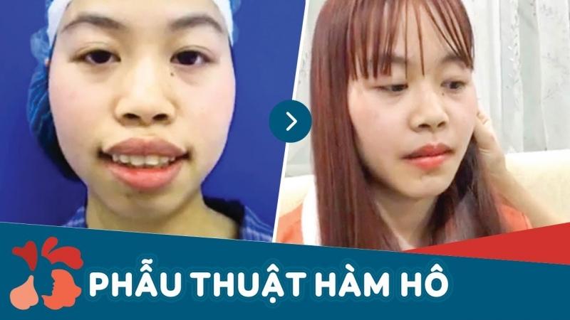 Cận cảnh kết quả phẫu thuật chỉnh hàm tại Kangnam