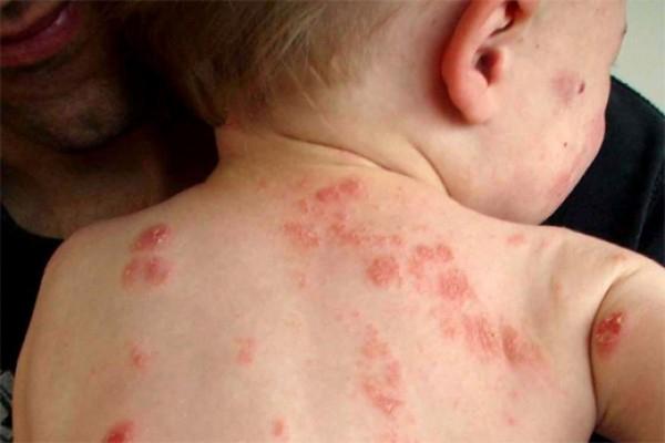 Zona thần kinh dễ lây cho trẻ em