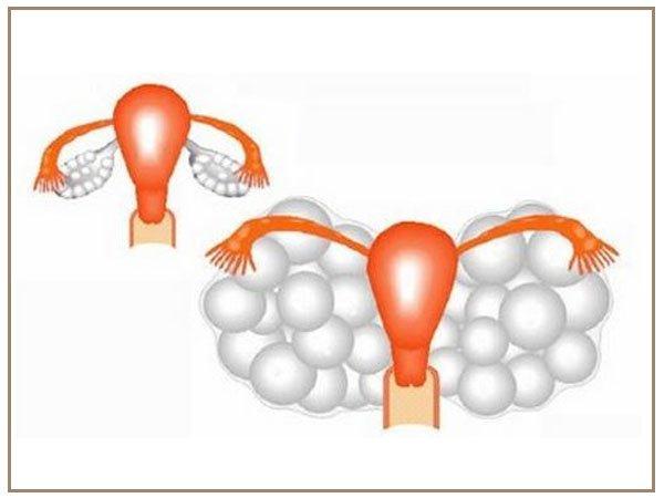 Đa thai là một trong những biến chứng có thể gặp ở phương pháp này