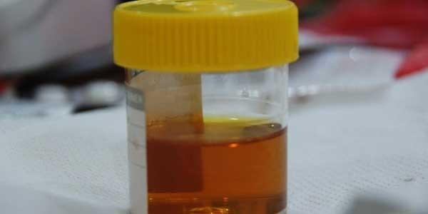 Nước tiểu sẫm màu là triệu chứng của ung thư gan