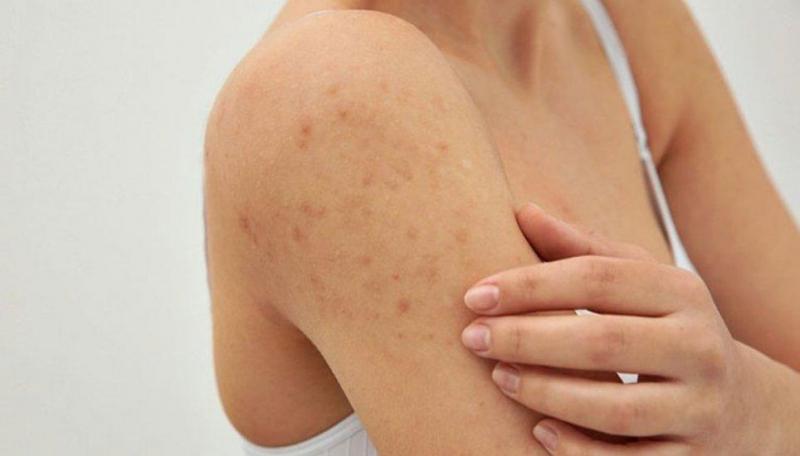 Chẩn đoán viêm nang lông