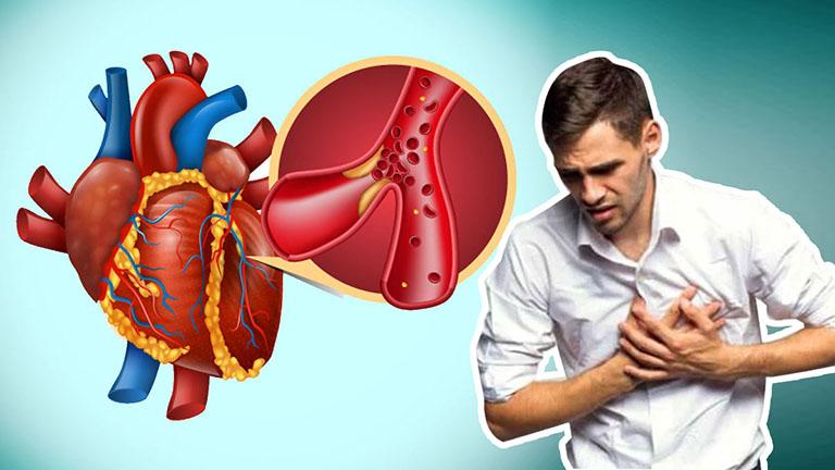 Các biến chứng nhồi máu cơ tim
