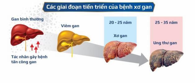 Các giai đoạn của xơ gan