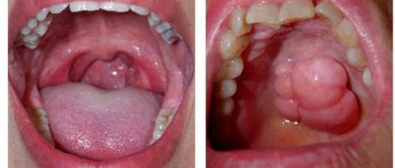 Việc xác định chính xác giai đoạn phát triển của khối u và vùng xâm lấn giúp các bác sĩ xây dựng phác đồ và kết hợp các phương pháp điều trị phù hợp.