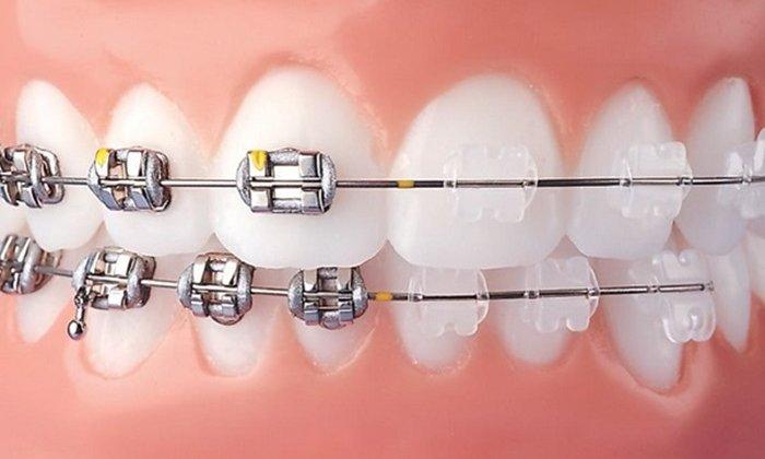 Tổng quan về niềng răng mắc cài tự buộc