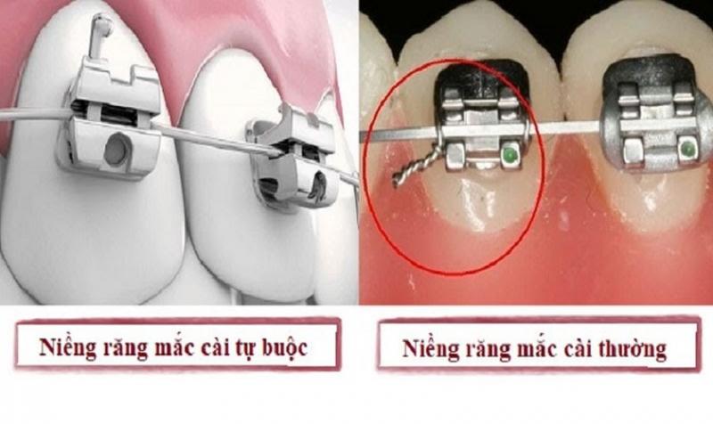 Các loại niềng rắng mắc cài sứ dây trong