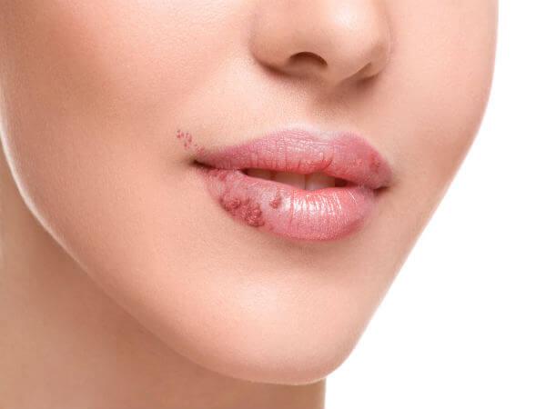 Các vết nứt ở khóe miệng