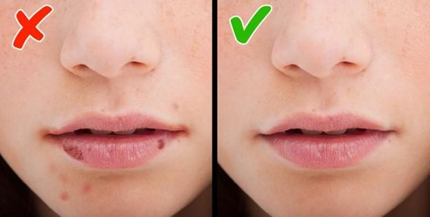Các vết nứt ở khóe miệng
