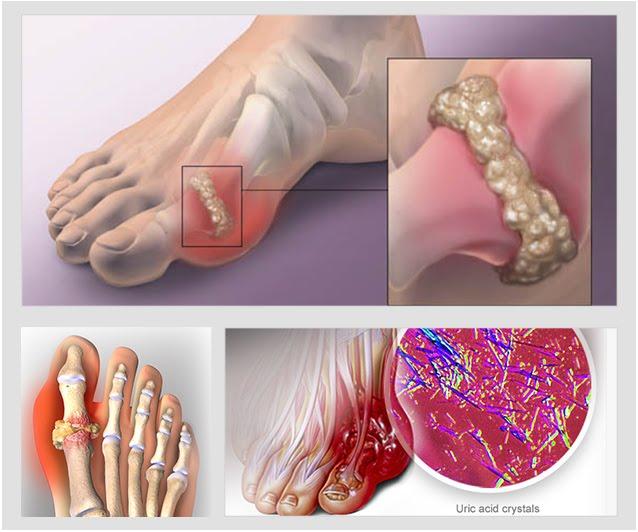 Cách chẩn đoán Gout