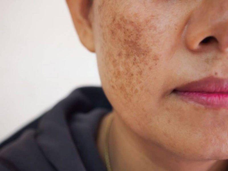 Phụ nữ sau sinh rất sợ nám da