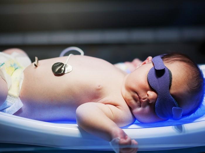 Cách điều trị vàng da bệnh lý ở trẻ sơ sinh