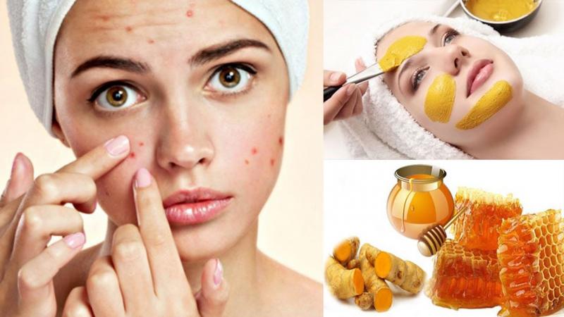 Cách trị mụn thâm bằng mật ong