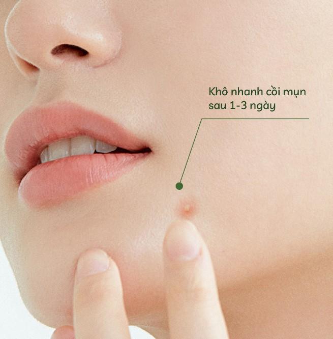Chấm mụn rau má Cỏ Mềm