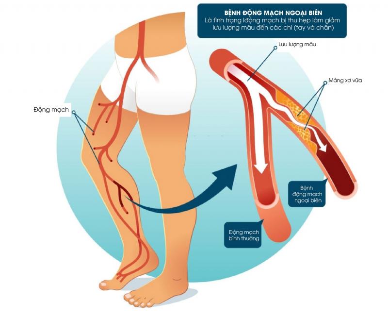 Chẩn đoán bệnh động mạch ngoại biên