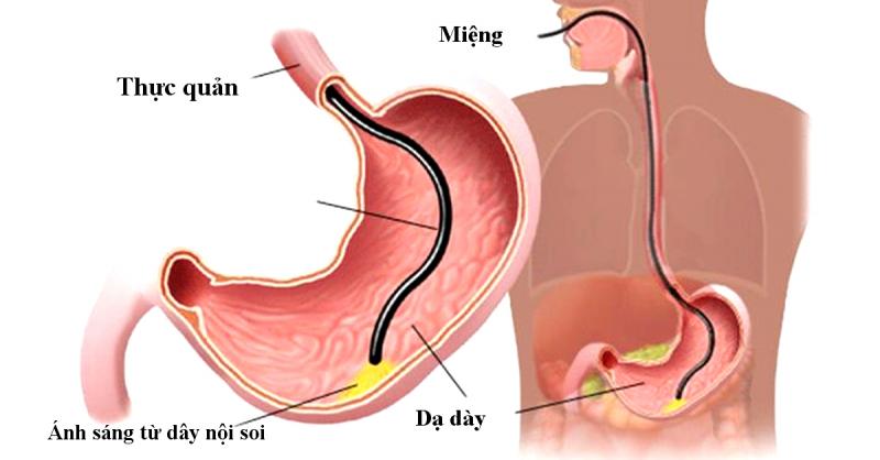 Nội soi dạ dày - tá tràng để phát hiện ổ loét
