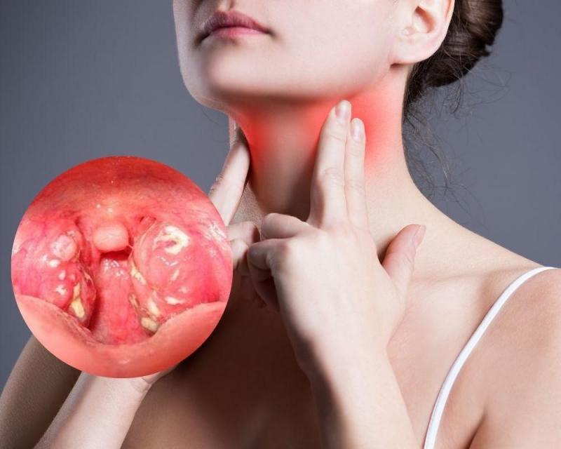 Sản phẩm được chỉ định trong trường hợp viêm amidan