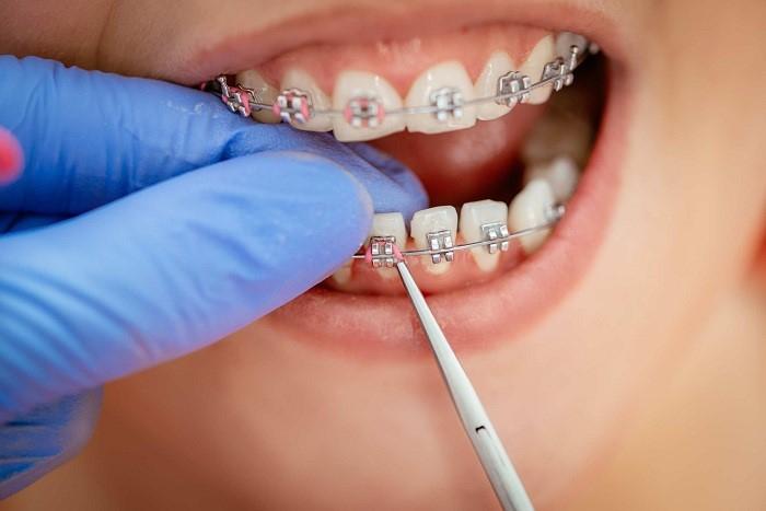 Chi phí niềng răng bằng vật liệu 3M