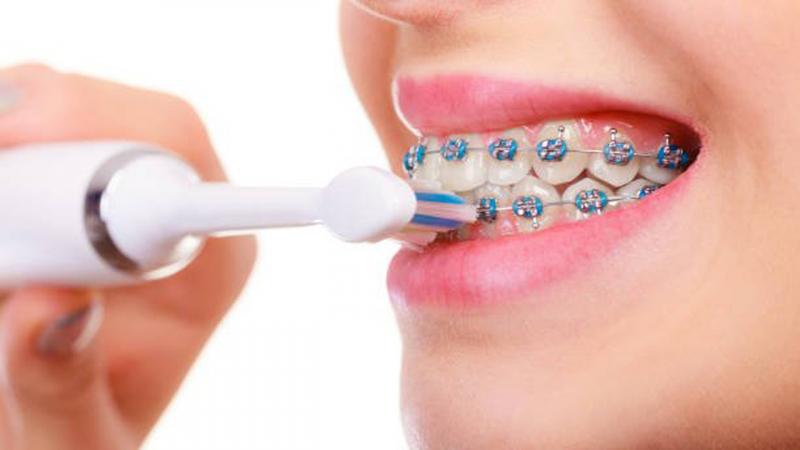 Chọn bàn chải phù hợp với người niềng răng