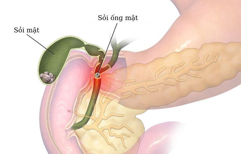 không sử dụng trường hợp bị tắc nghẽn ống mật