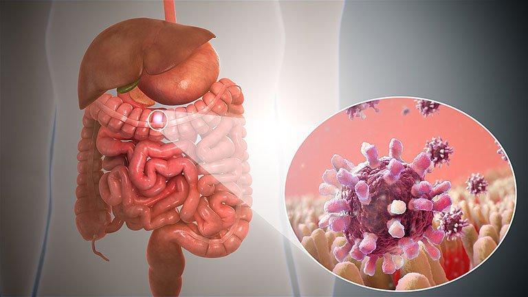 Bệnh nhân bị viêm ruột do sự xâm nhập của vi trùng