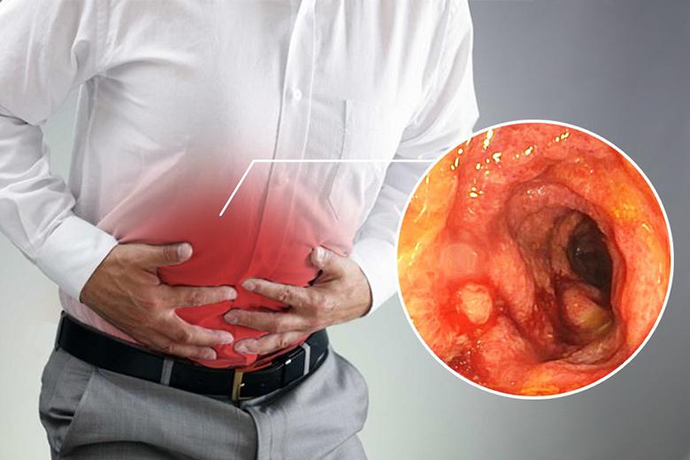 Bệnh nhân đang trong quá trình điều trị viêm loét đại tràng cấp